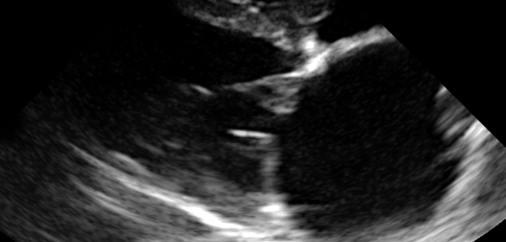 Endocardiose